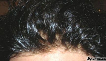 La mejores protesis capilares y pelucas invisibles de Espa&ntilde;a