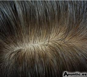 La mejores protesis capilares y pelucas invisibles de Espa&ntilde;a