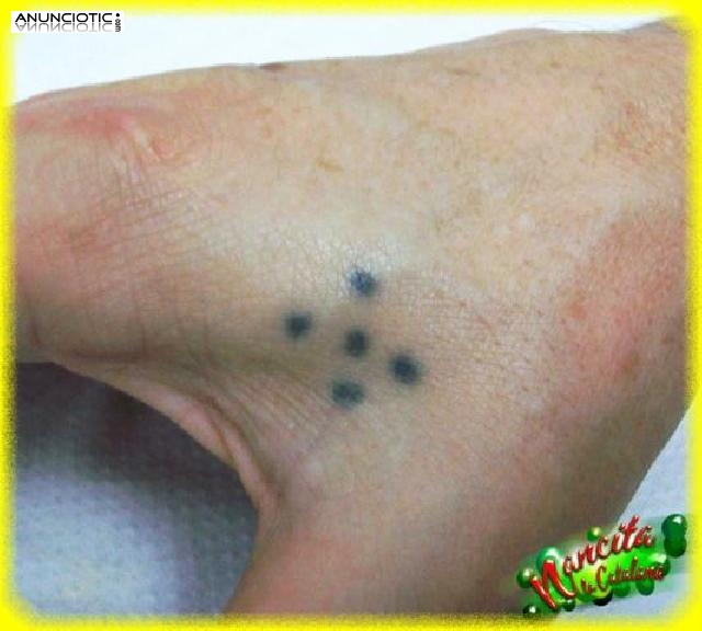 ELIMINAMOS TATUAJES INDESEADOS EN MANOS Y DEDOS