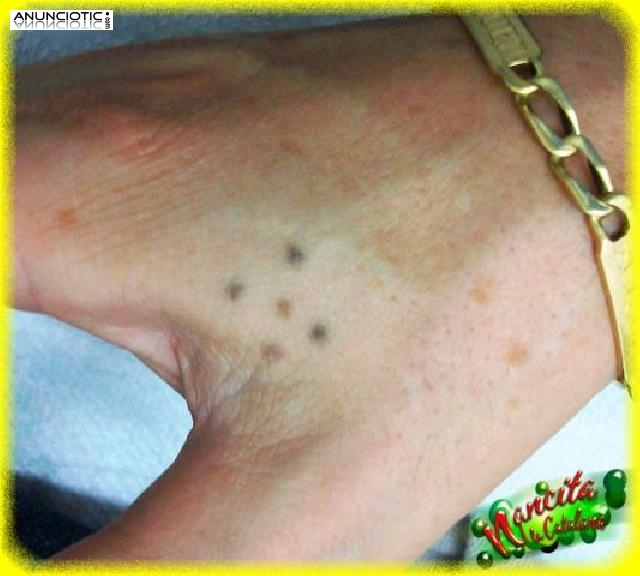 ELIMINAMOS TATUAJES INDESEADOS EN MANOS Y DEDOS