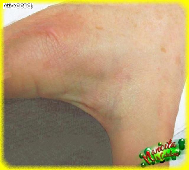 ELIMINAMOS TATUAJES INDESEADOS EN MANOS Y DEDOS