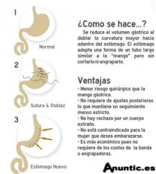 Plicatura gastrica. Hospital Modelo. Dr. Mena del R&iacute;o