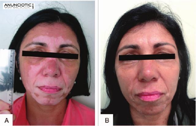 Milagro para el Vit&iacute;ligo