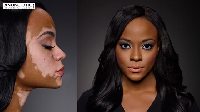 Milagro para el Vit&iacute;ligo