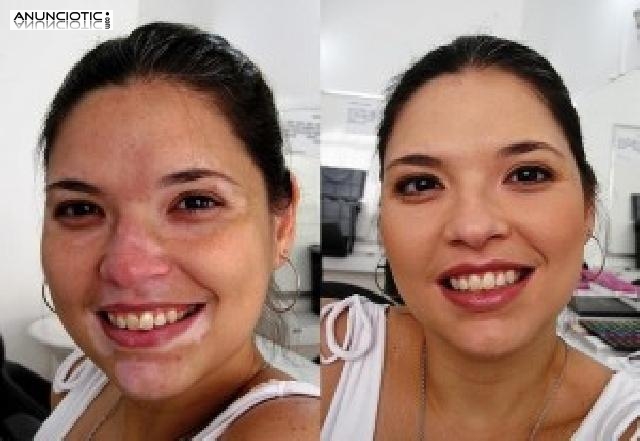 Lo &Uacute;ltimo y Soluci&oacute;n para el Vit&iacute;ligo