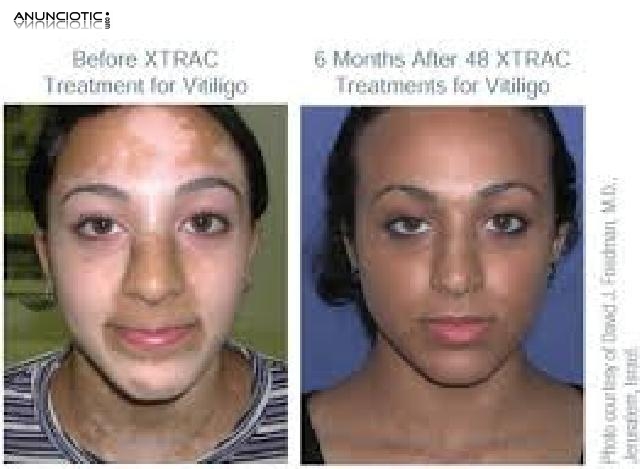 Lo &Uacute;ltimo y Soluci&oacute;n para el Vit&iacute;ligo