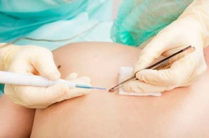 melanoma-diagnostico